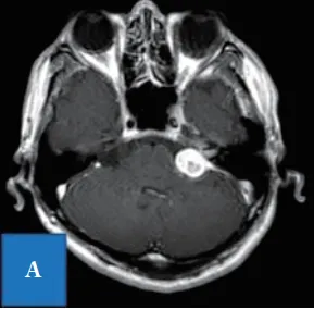 聽神經瘤案例圖片
